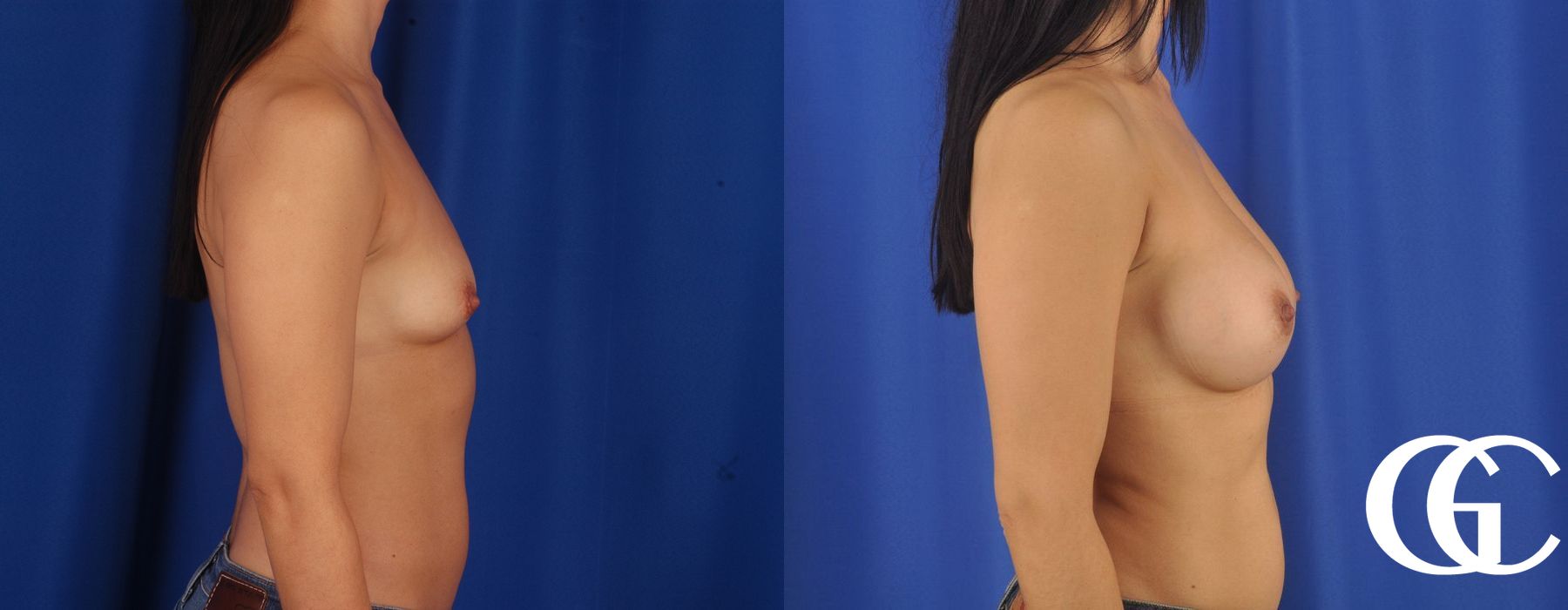 Breast Augmentation - Thumbnail 3