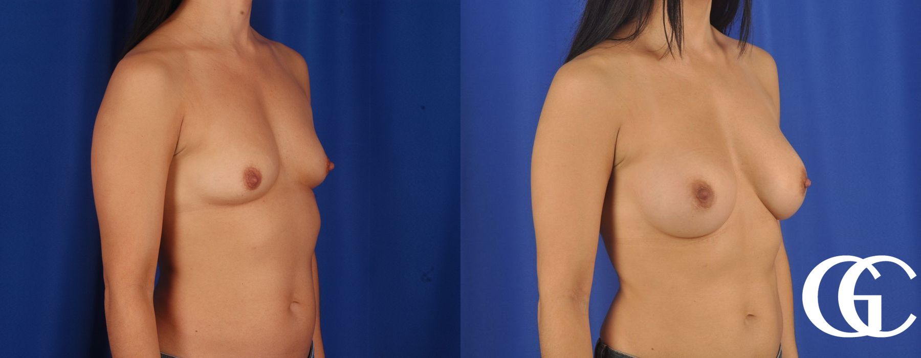 Breast Augmentation - Case 7051