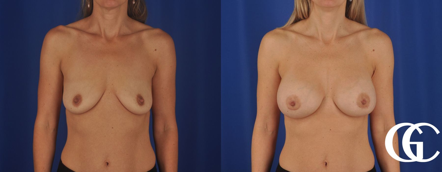 Breast Augmentation - Thumbnail 2
