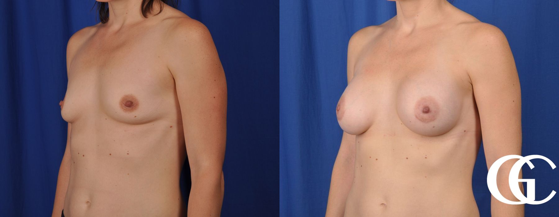 Breast Augmentation - Thumbnail 4