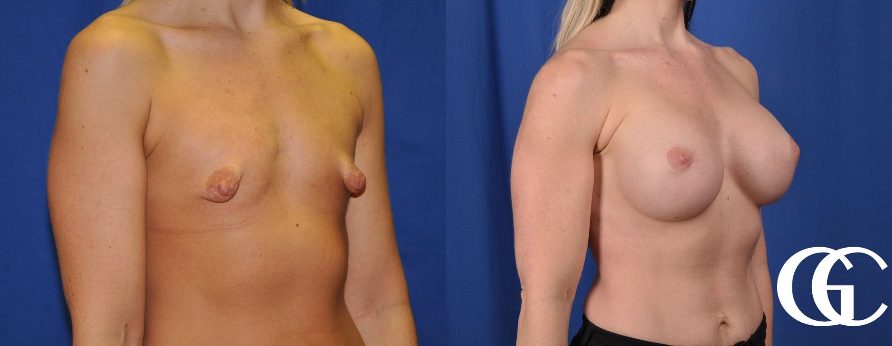 Breast Augmentation - Thumbnail 3