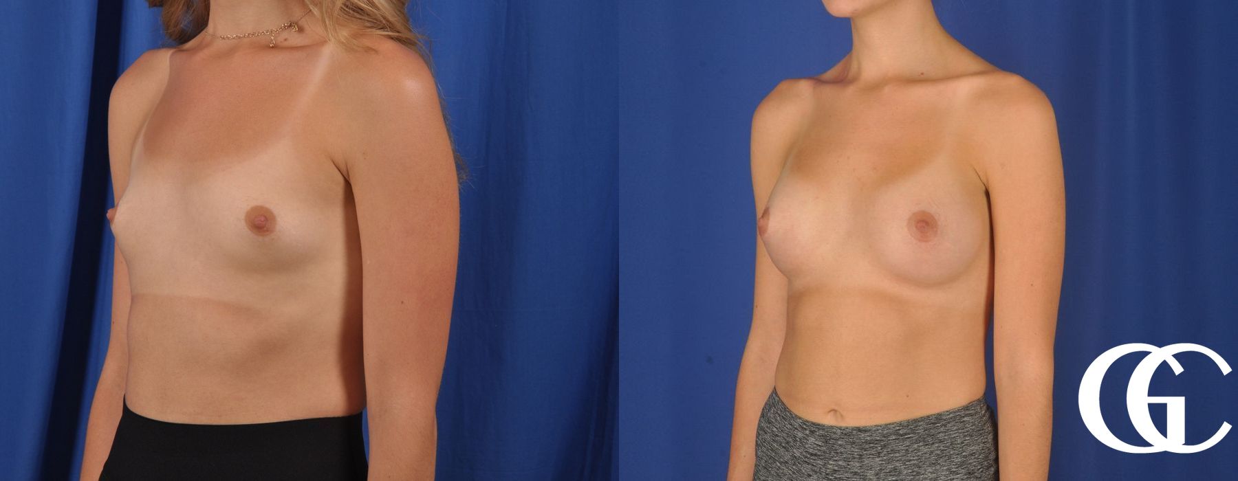Breast Augmentation - Thumbnail 4