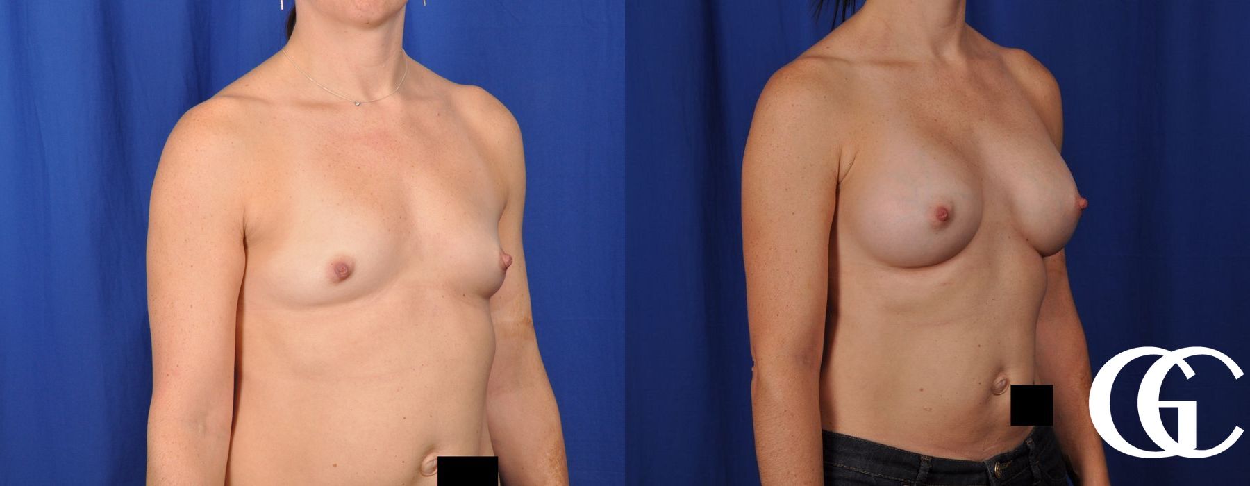 Breast Augmentation - Thumbnail 2