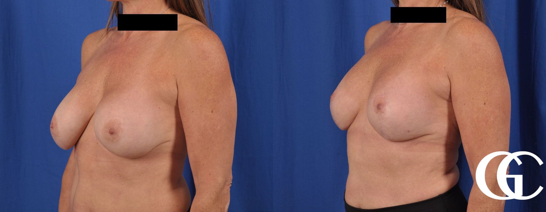 Breast Augmentation - Thumbnail 5