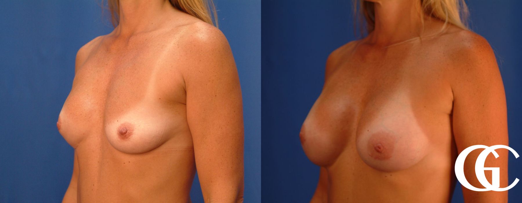 Breast Augmentation - Thumbnail 3