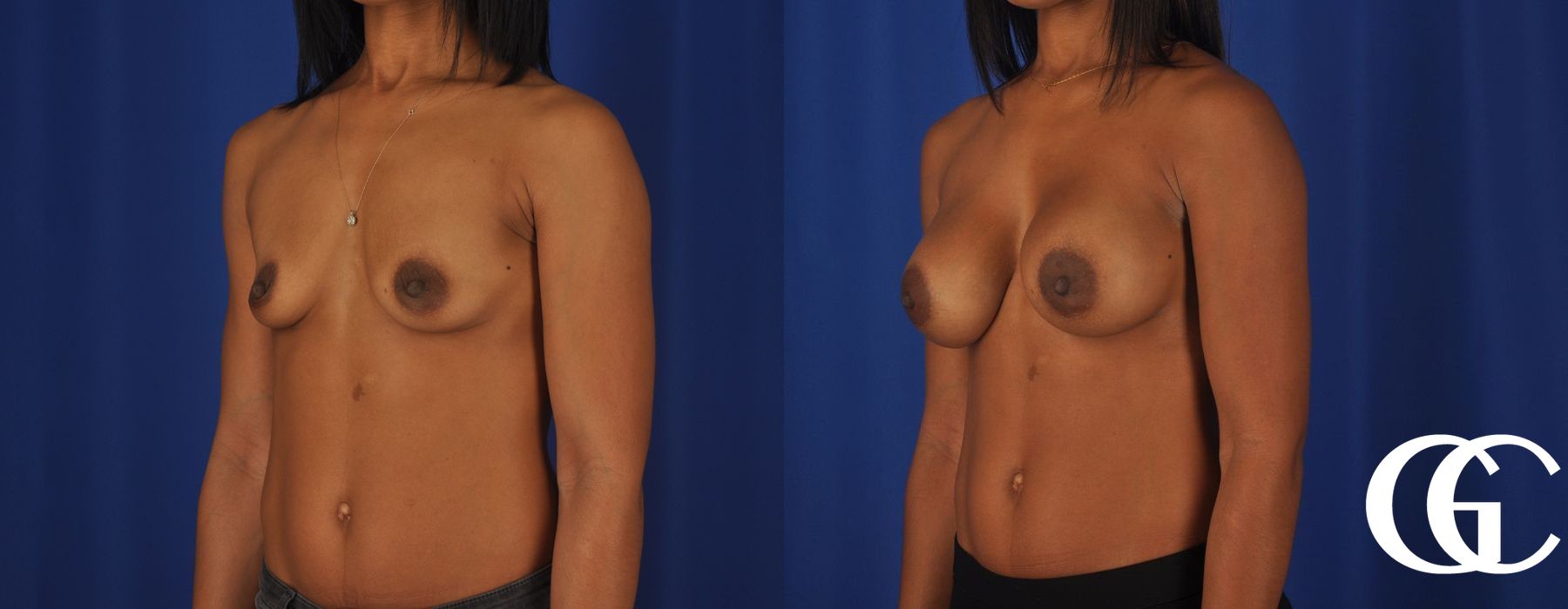Breast Augmentation - Thumbnail 4