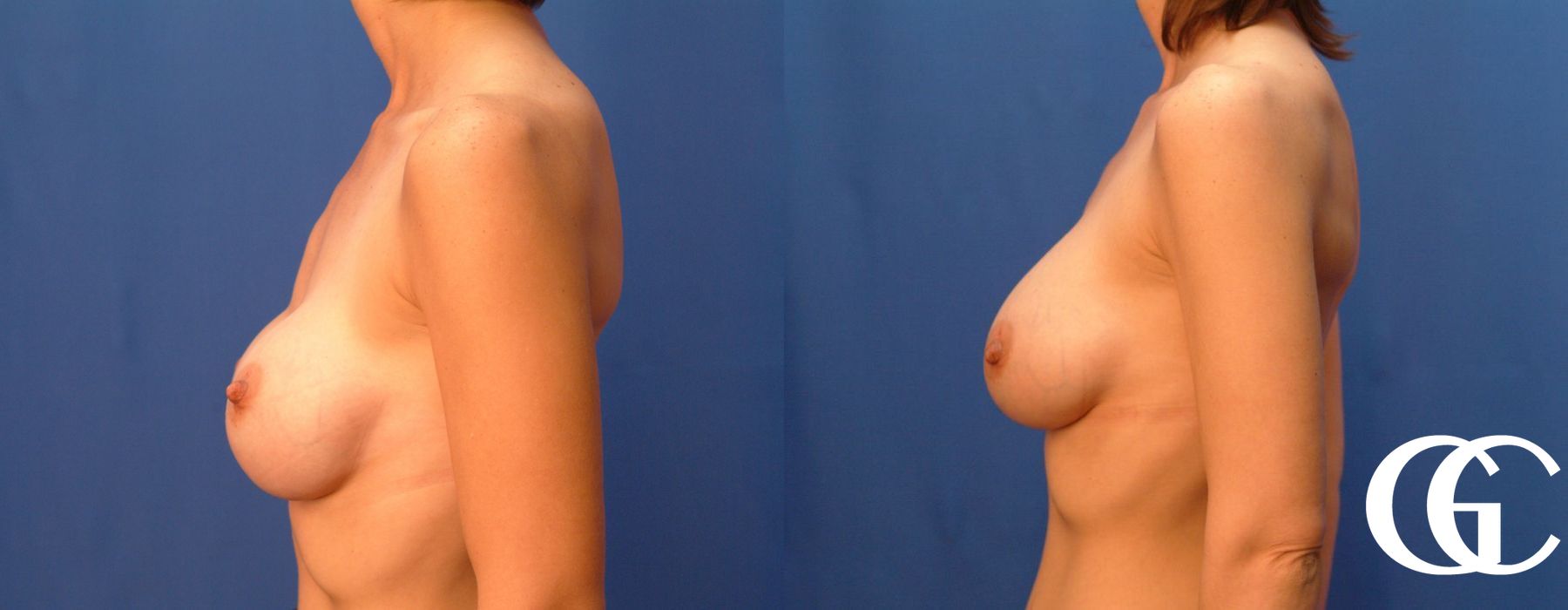 Breast Augmentation - Thumbnail 2