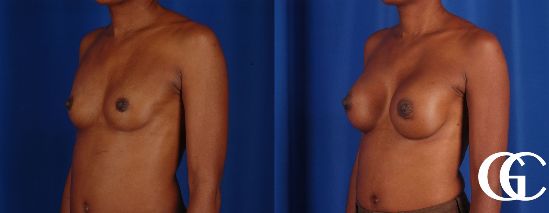 Breast Augmentation - Thumbnail 5