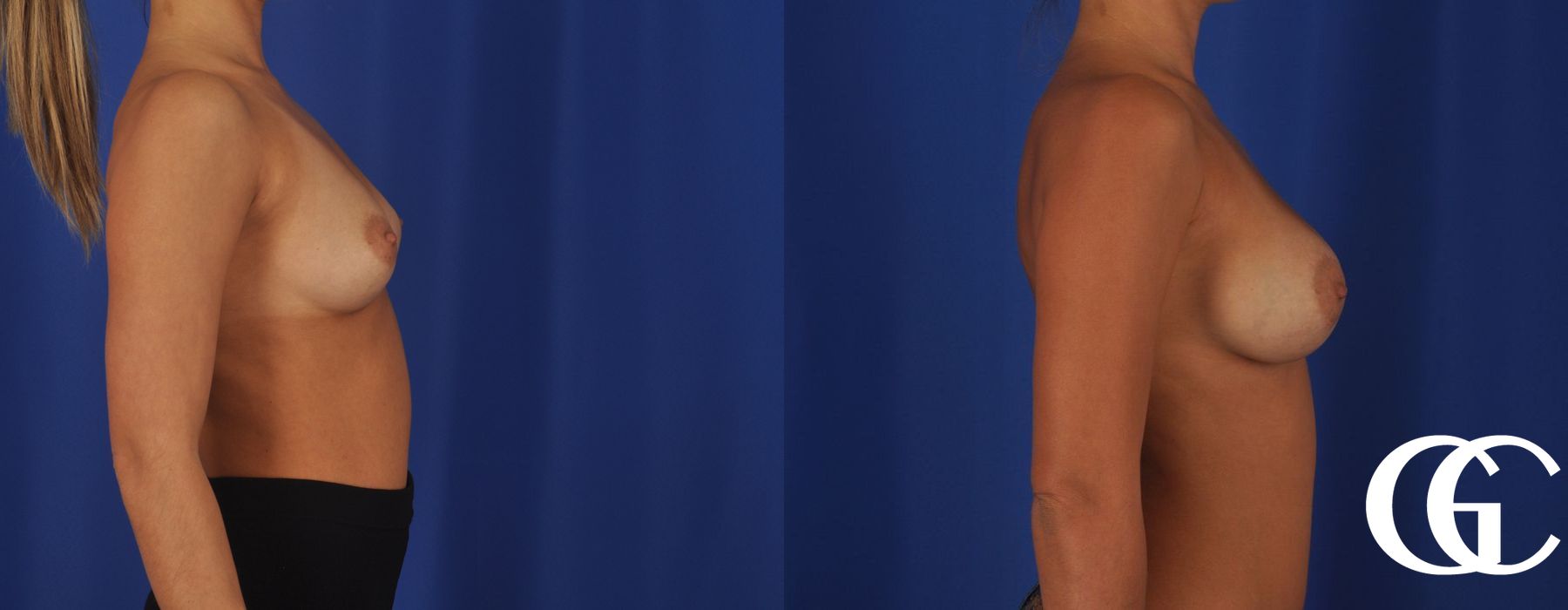 Breast Augmentation - Thumbnail 4