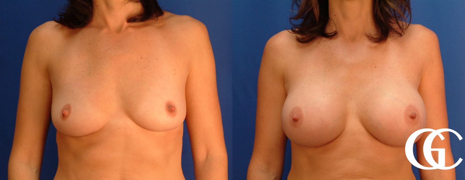 Breast Augmentation - Thumbnail 3