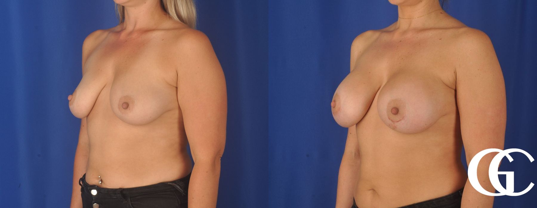 Breast Augmentation - Thumbnail 2