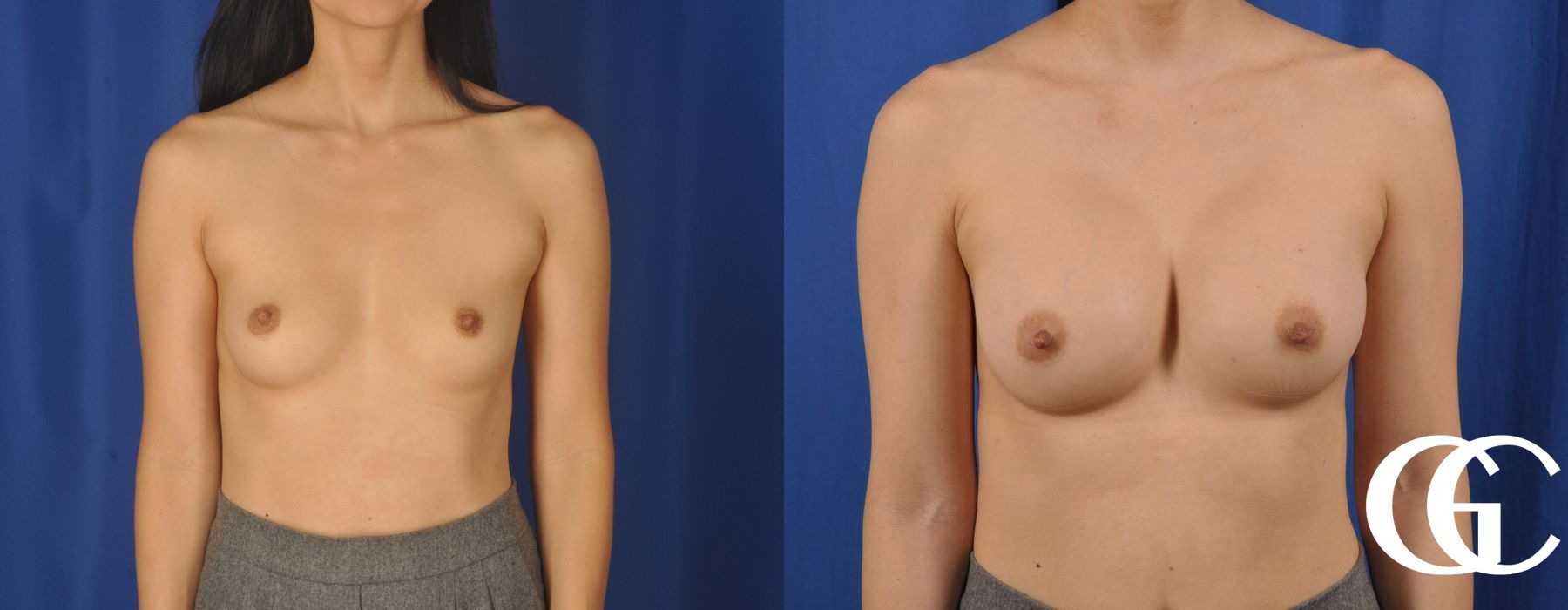 Breast Augmentation - Thumbnail 2