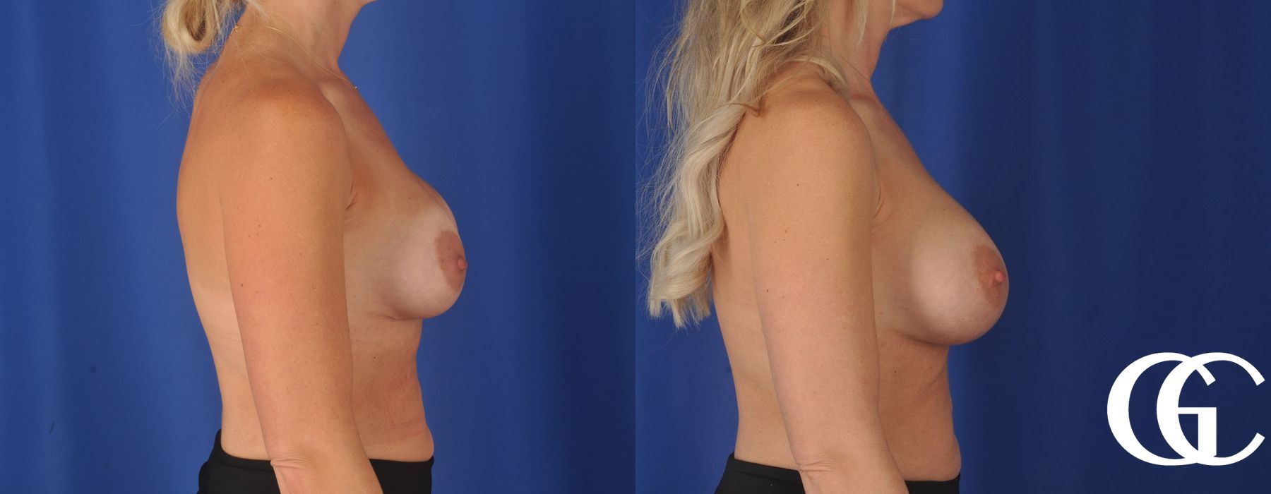 Breast Augmentation - Thumbnail 3