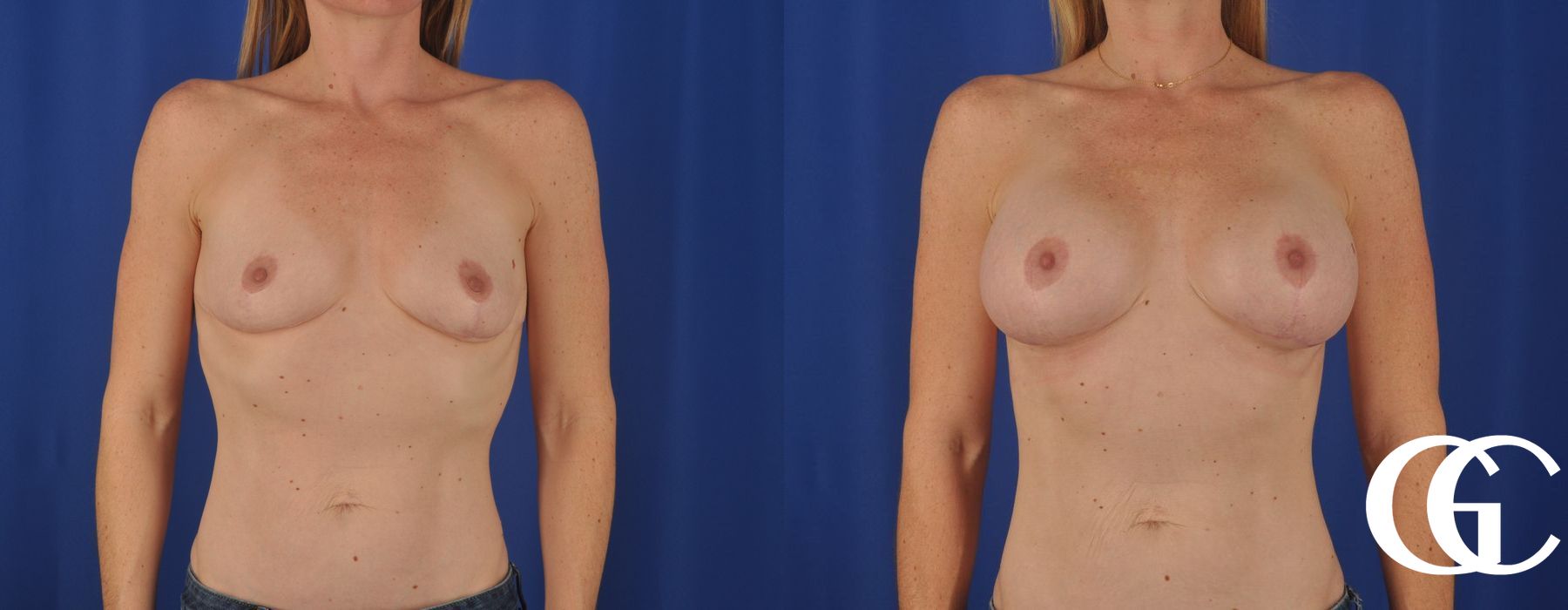 Breast Augmentation - Case 7124