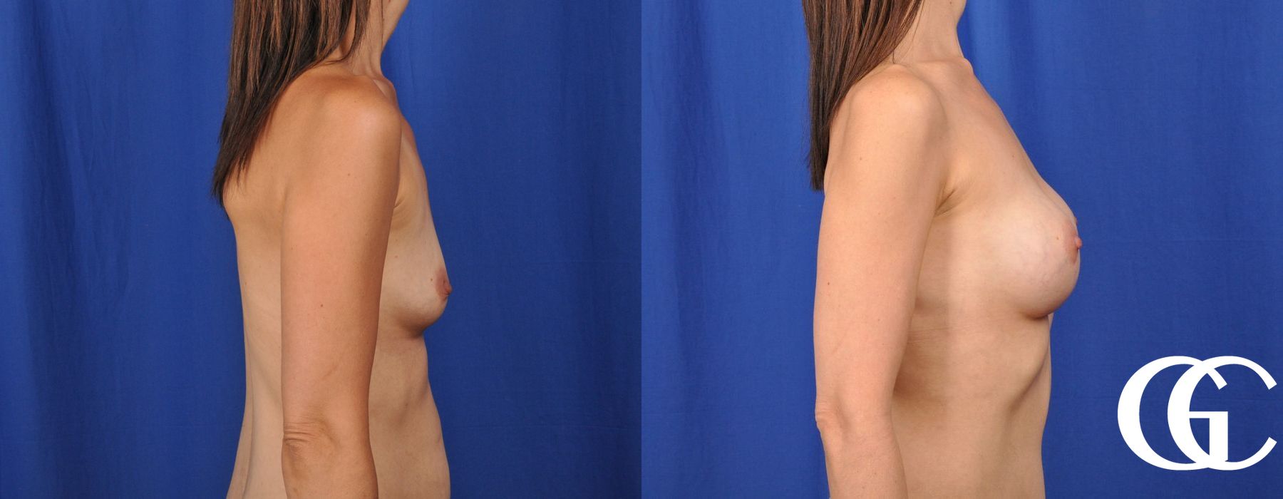 Breast Augmentation - Thumbnail 2