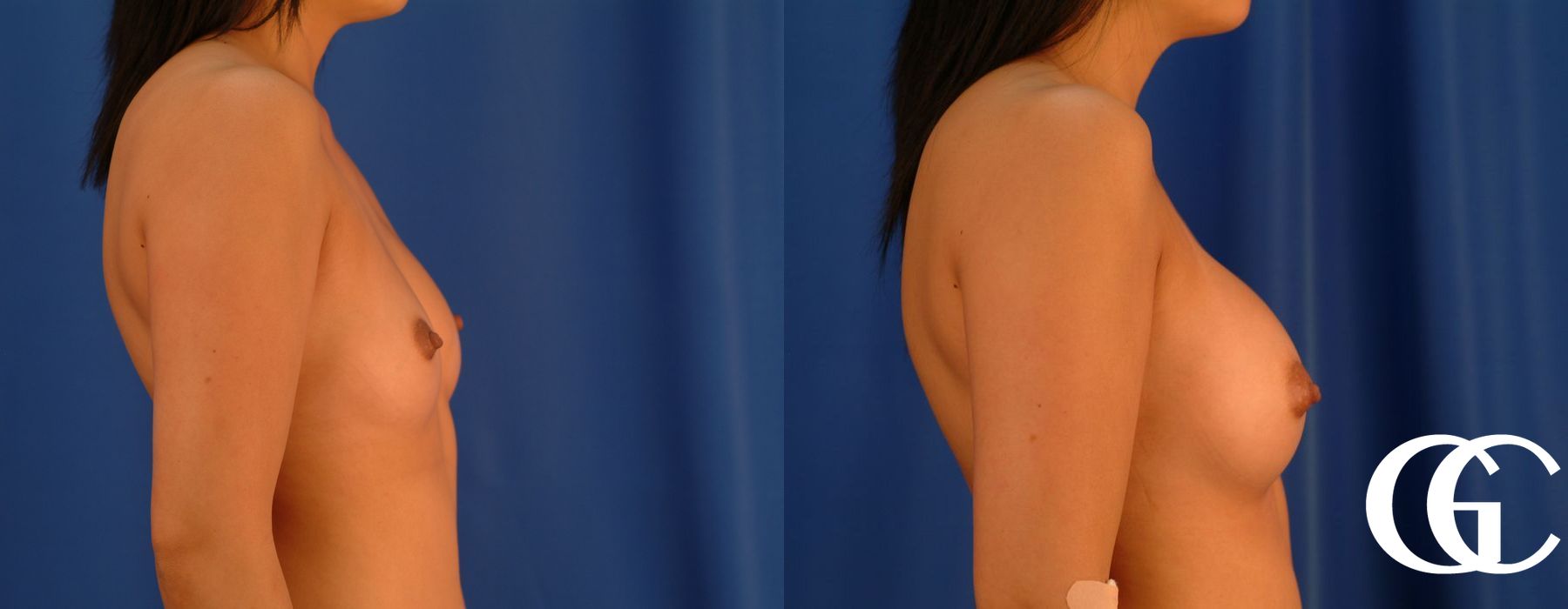 Breast Augmentation - Thumbnail 3