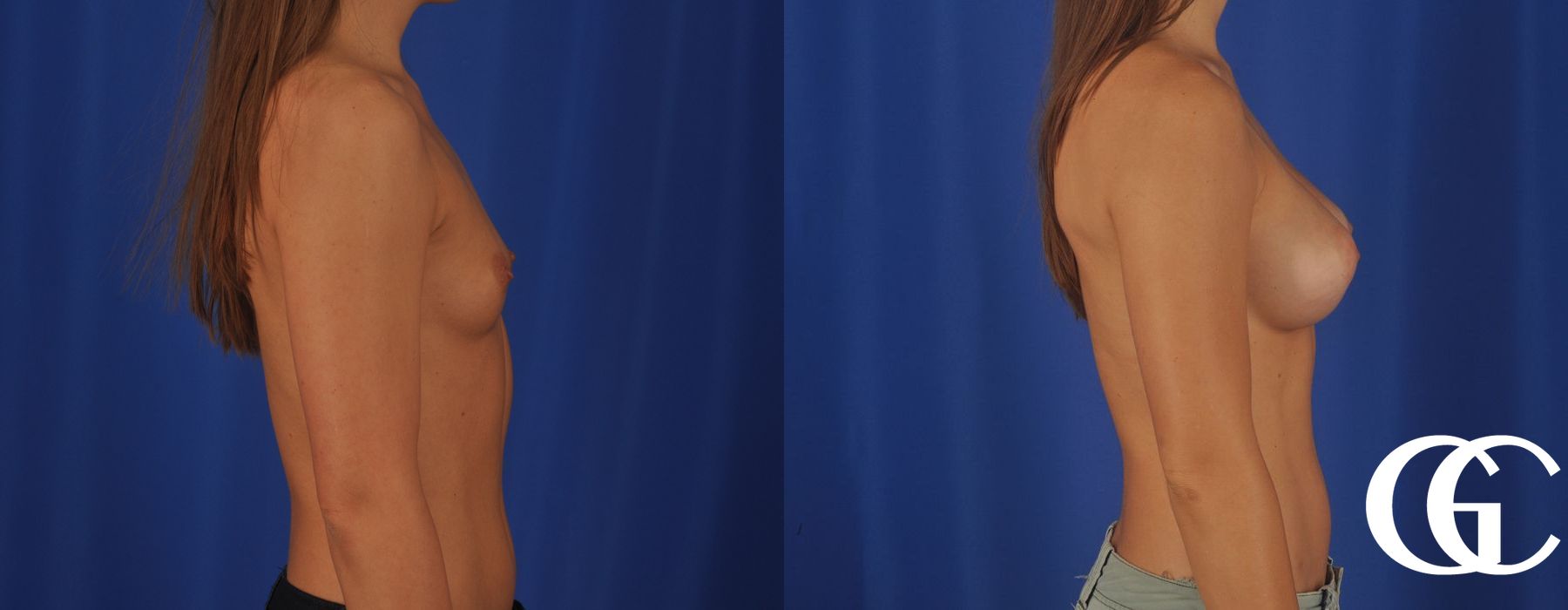 Breast Augmentation - Case 7118