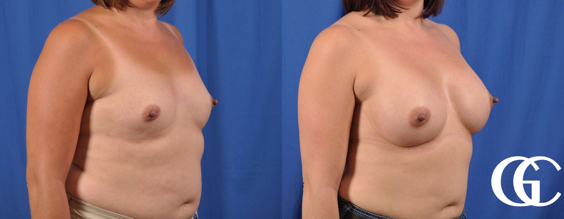 Breast Augmentation - Case 7172