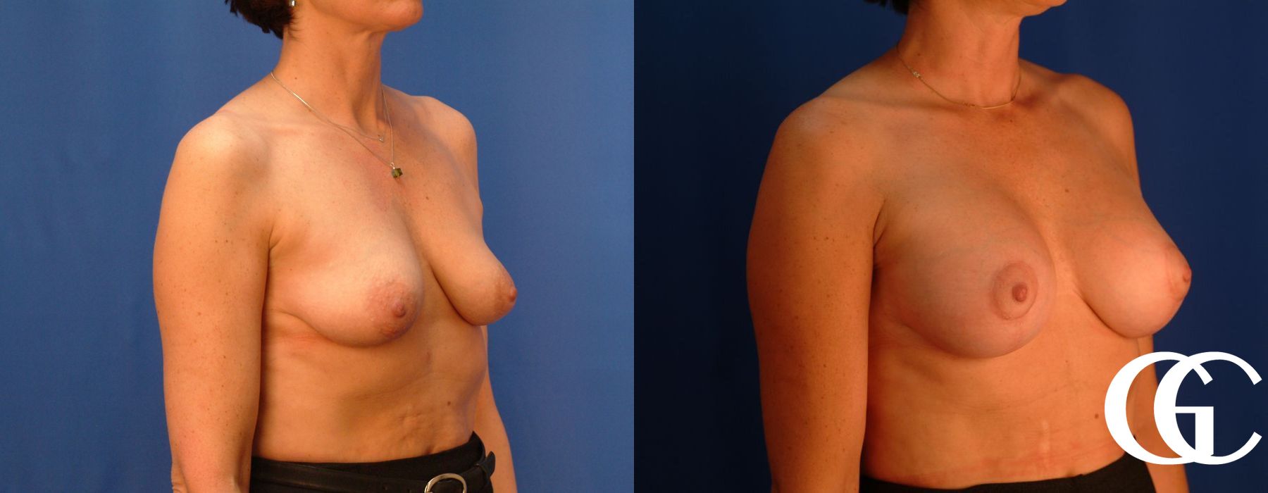 Breast Augmentation - Thumbnail 4
