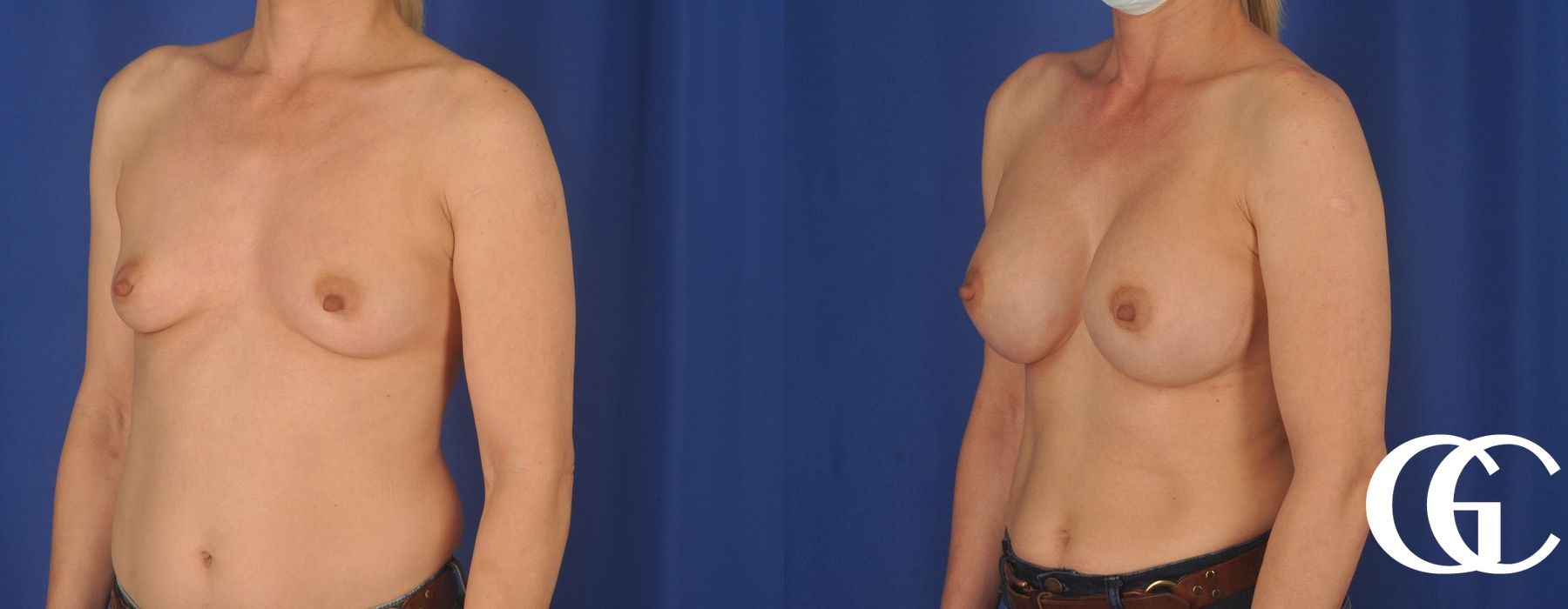 Breast Augmentation - Thumbnail 2