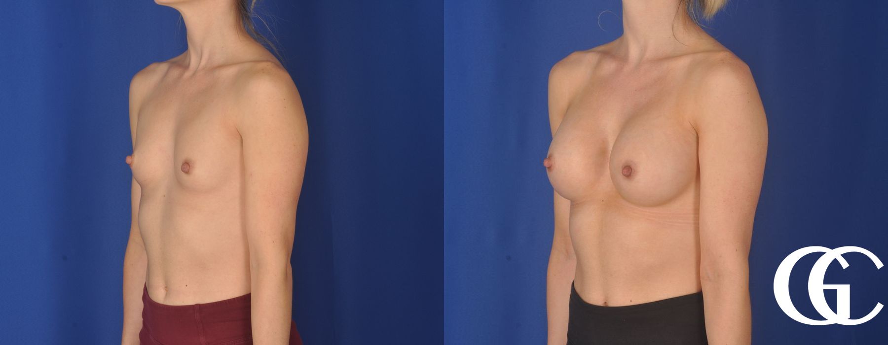 Breast Augmentation - Thumbnail 3