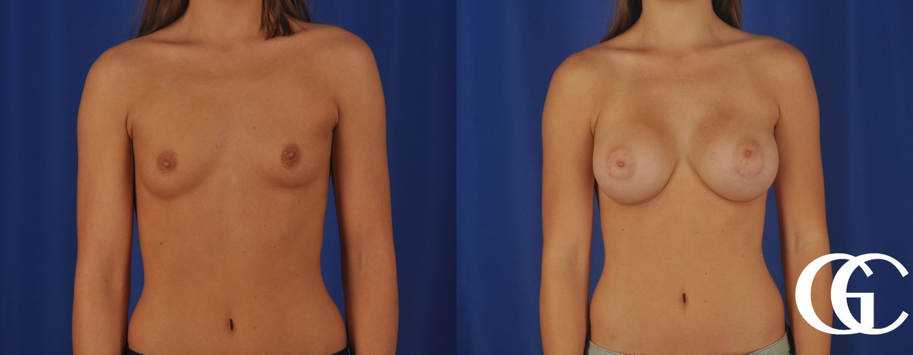Breast Augmentation - Thumbnail 3