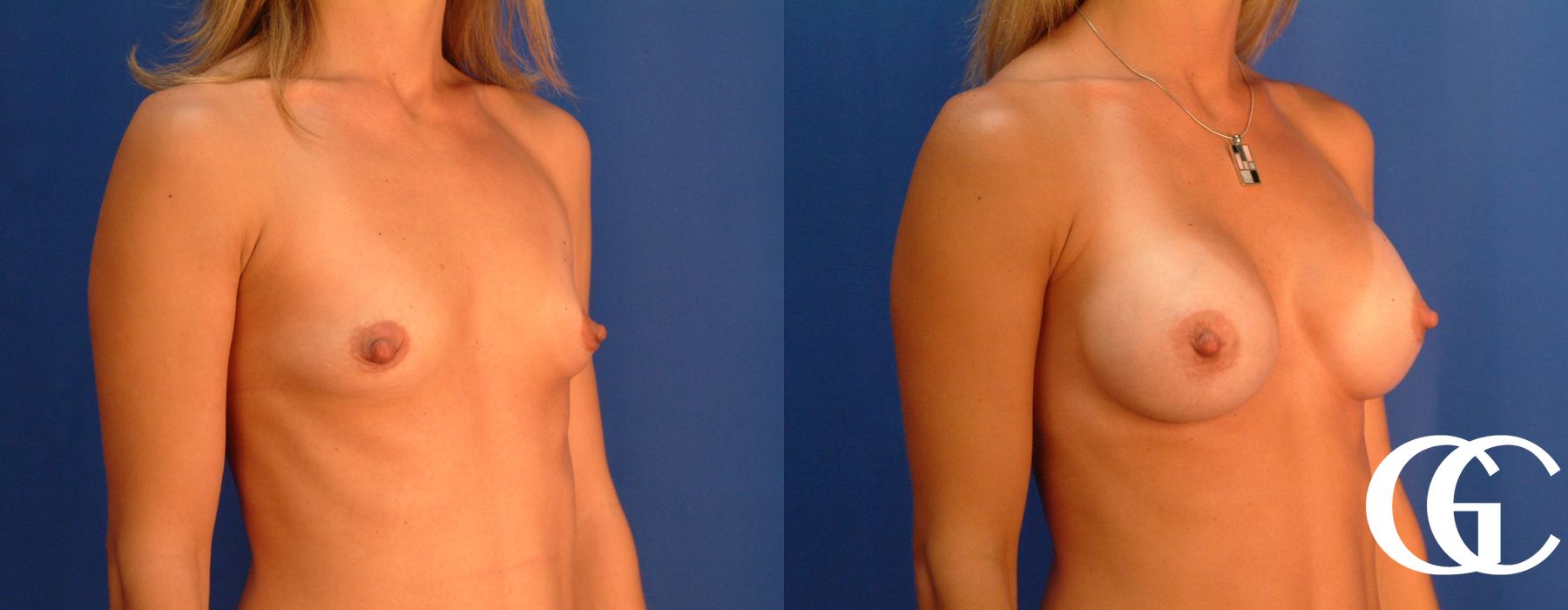 Breast Augmentation - Thumbnail 4