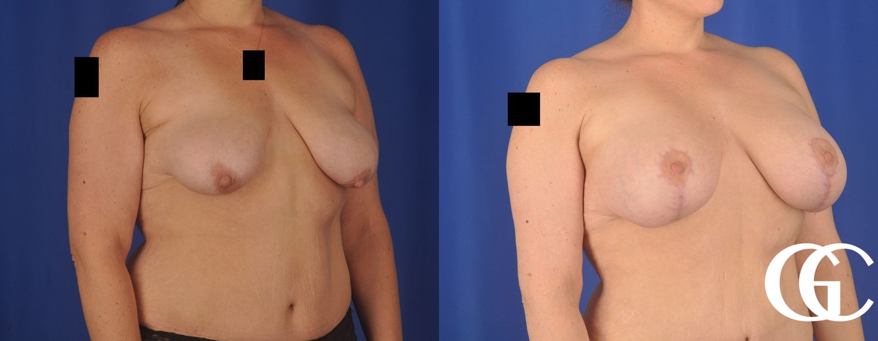 Breast Augmentation - Thumbnail 2