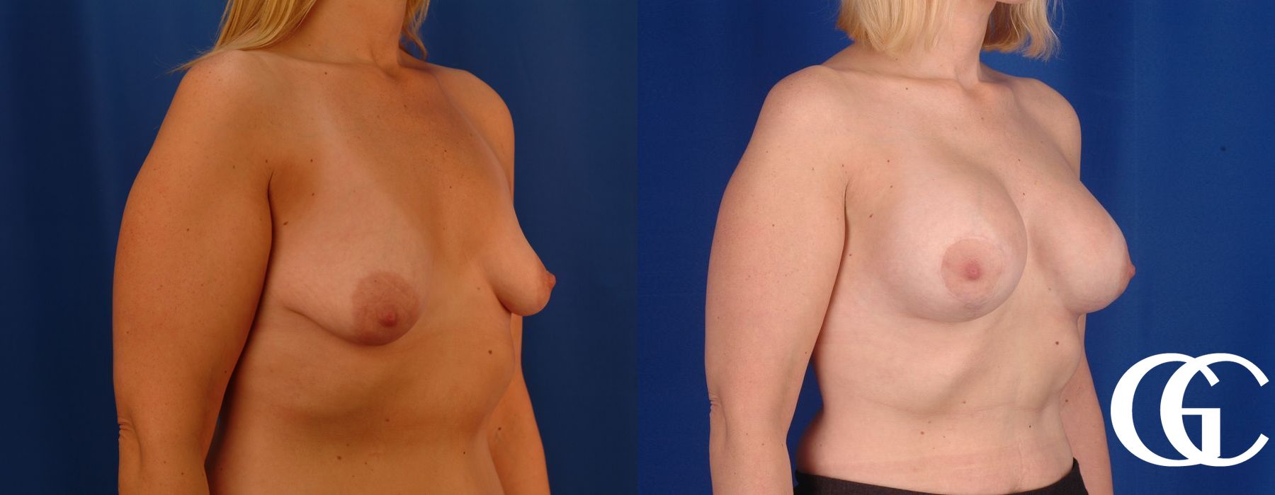 Breast Augmentation - Case 7200
