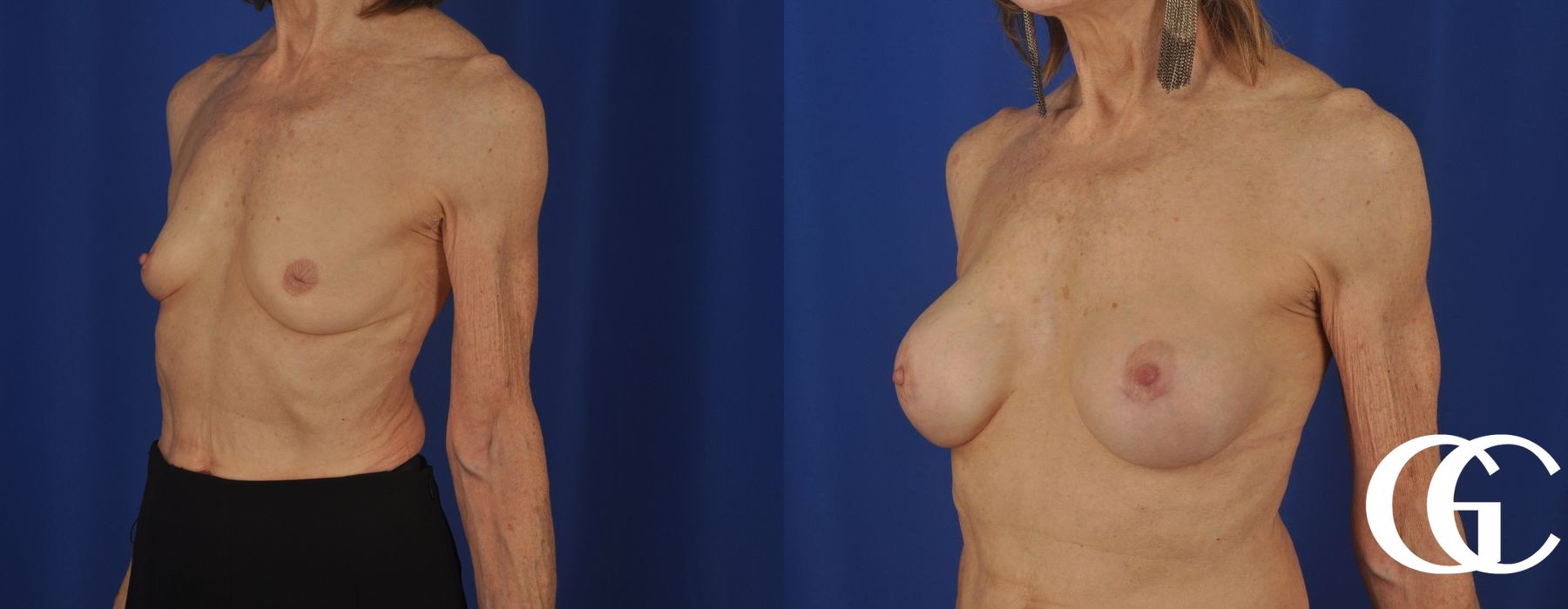 Breast Augmentation - Thumbnail 4