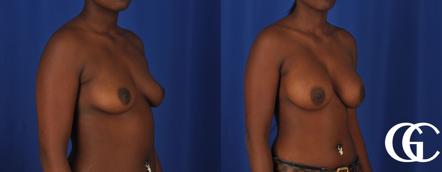 Breast Augmentation - Thumbnail 4