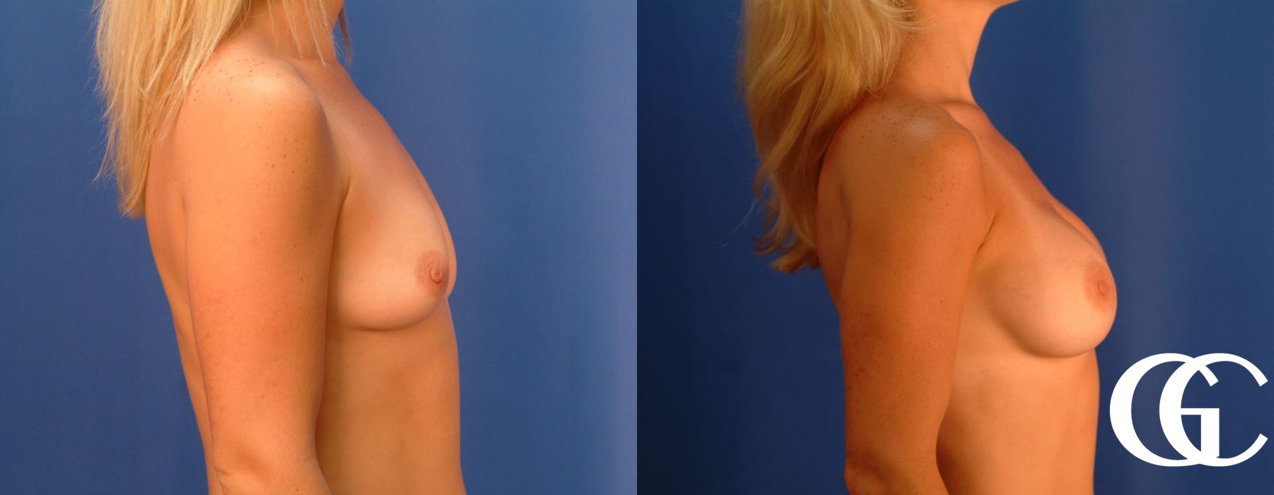 Breast Augmentation - Thumbnail 4
