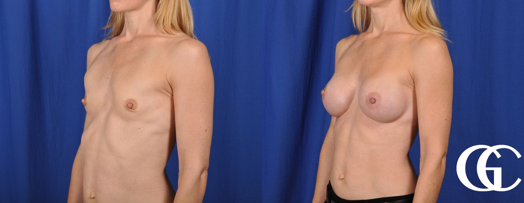 Breast Augmentation - Thumbnail 4