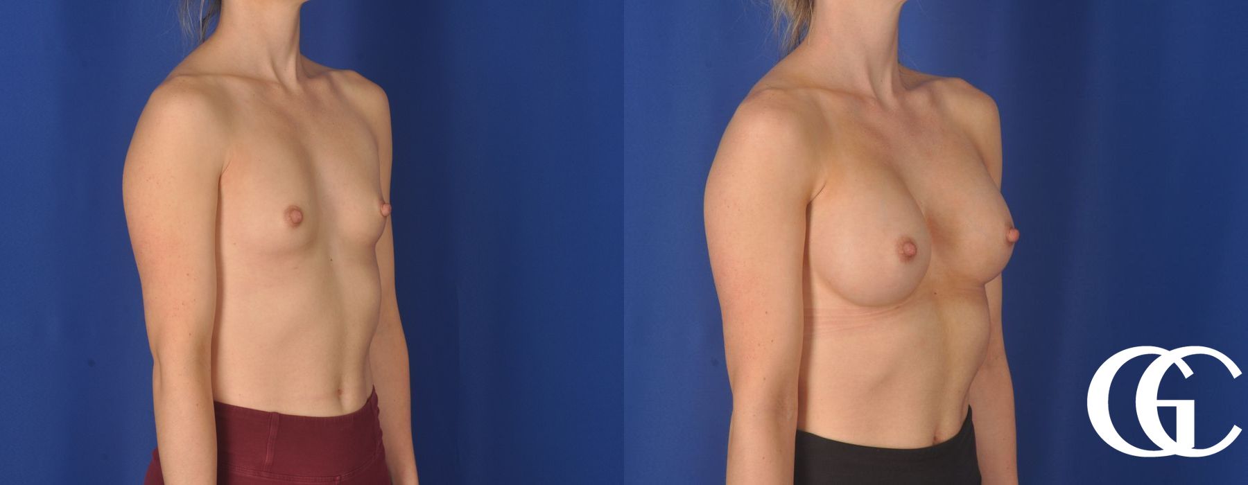 Breast Augmentation - Thumbnail 2