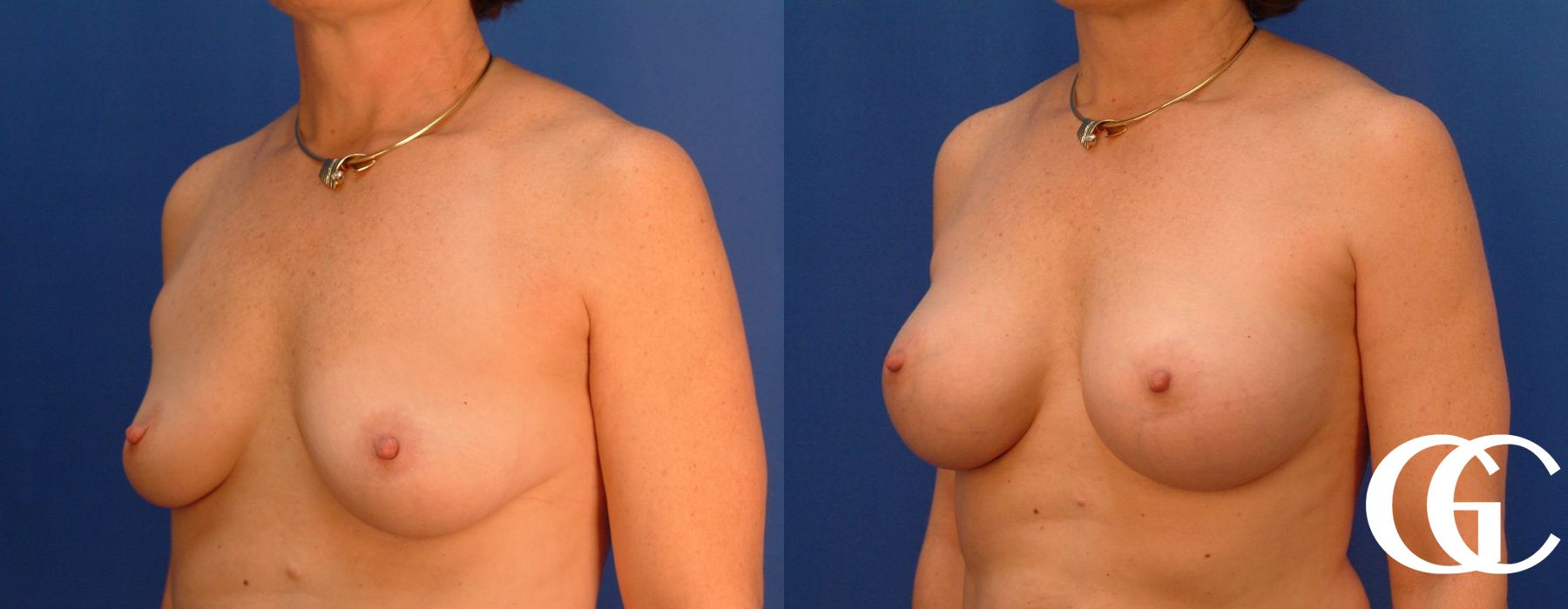 Breast Augmentation - Case 7103