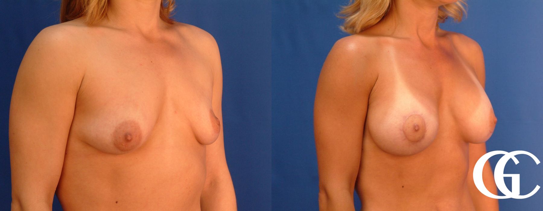 Breast Augmentation - Thumbnail 4