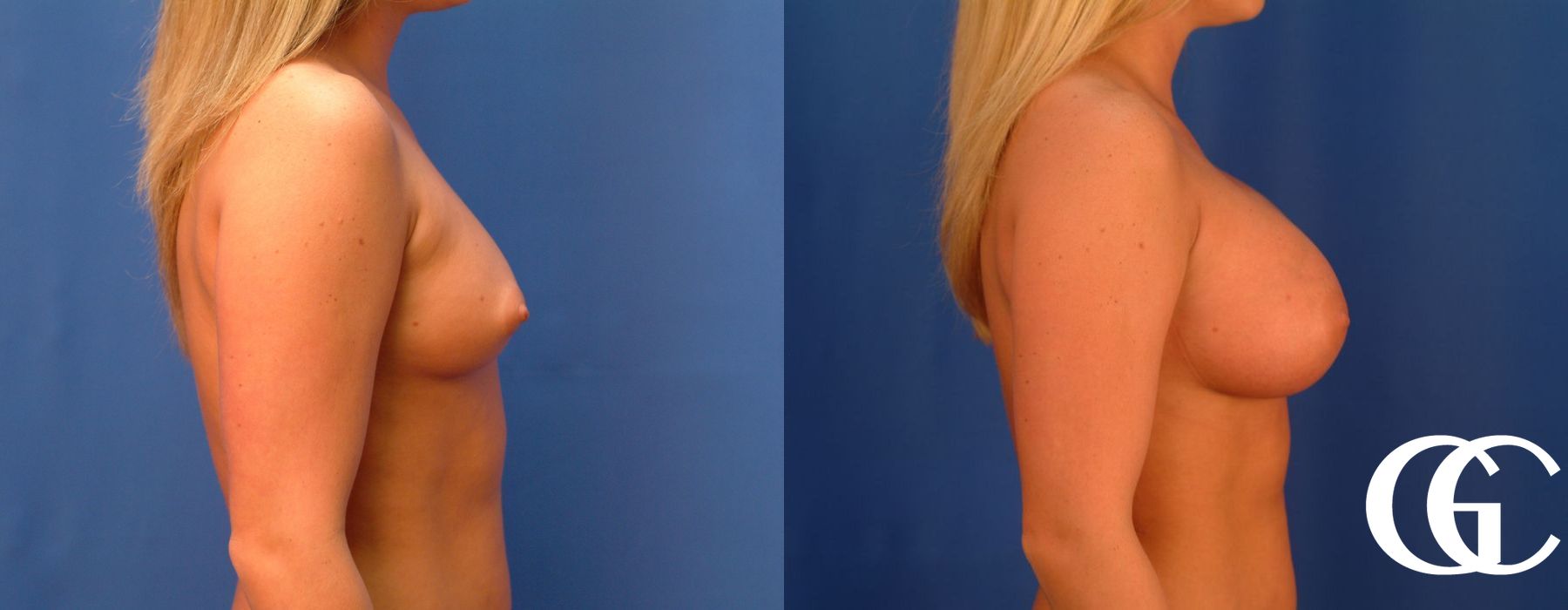 Breast Augmentation - Thumbnail 3