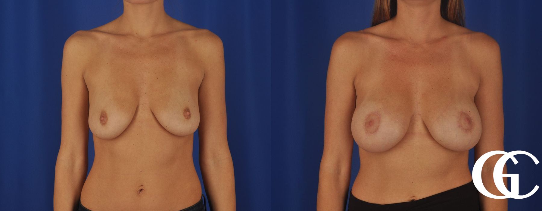 Breast Augmentation - Case 7140