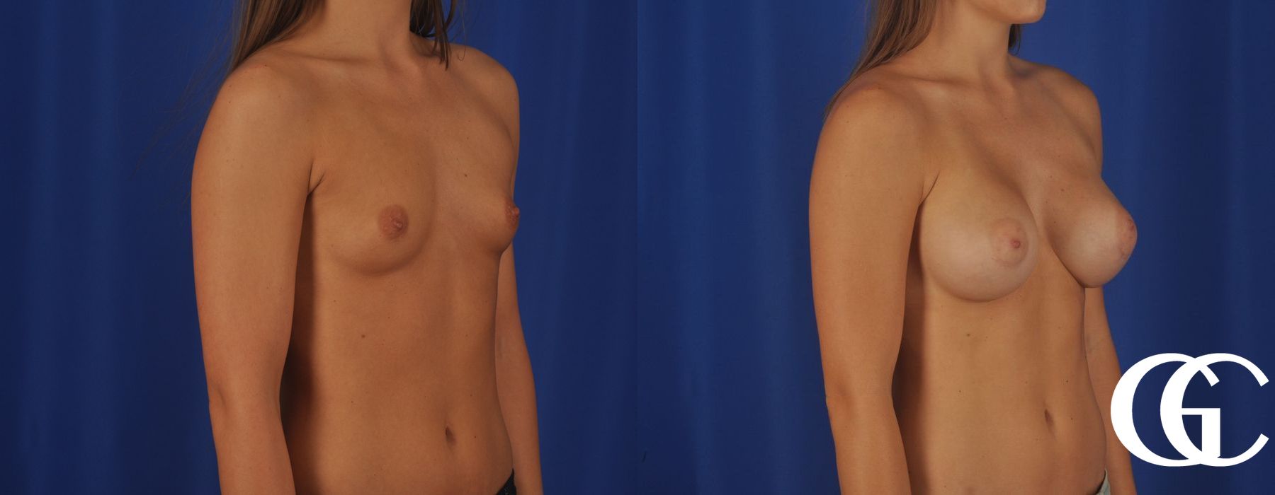 Breast Augmentation - Thumbnail 4