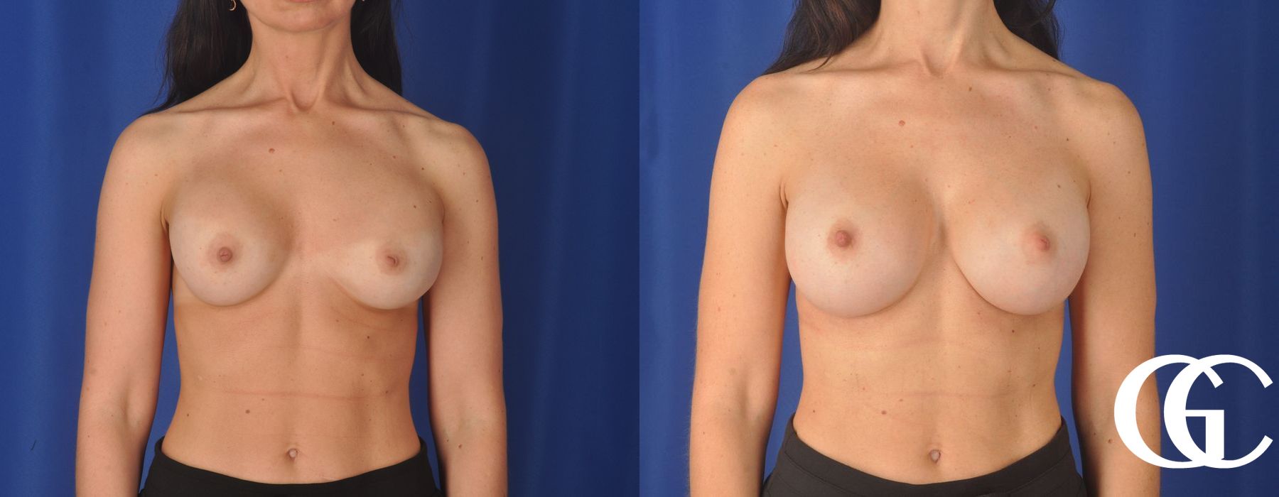 Breast Augmentation - Thumbnail 2