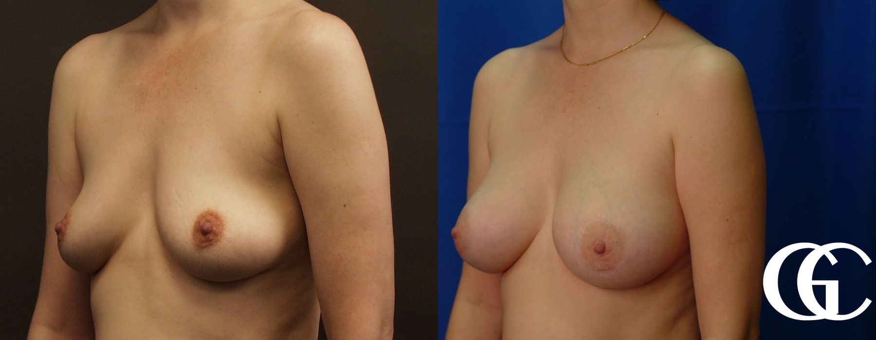 Breast Augmentation - Case 7077