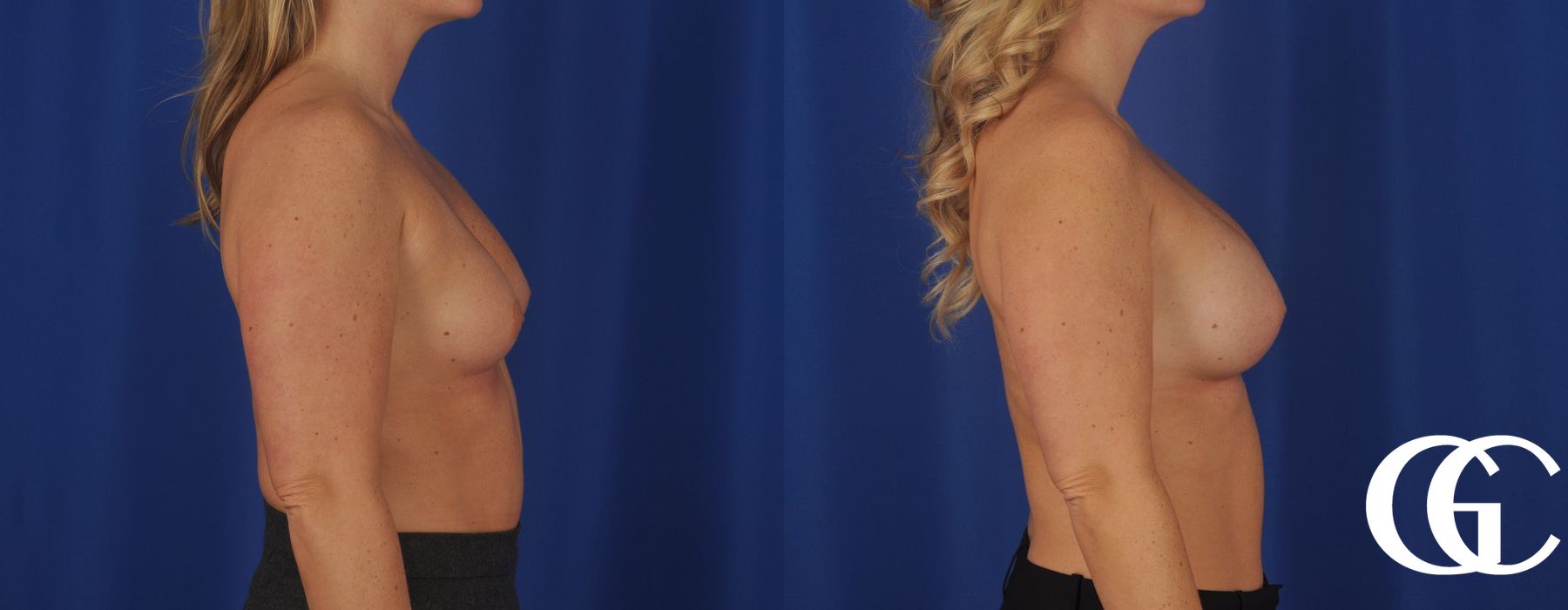 Breast Augmentation - Thumbnail 2