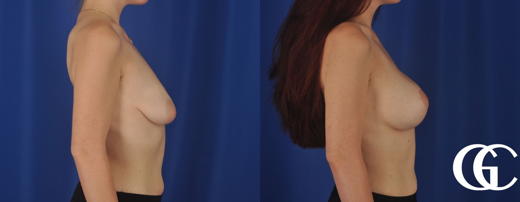 Breast Augmentation - Thumbnail 4