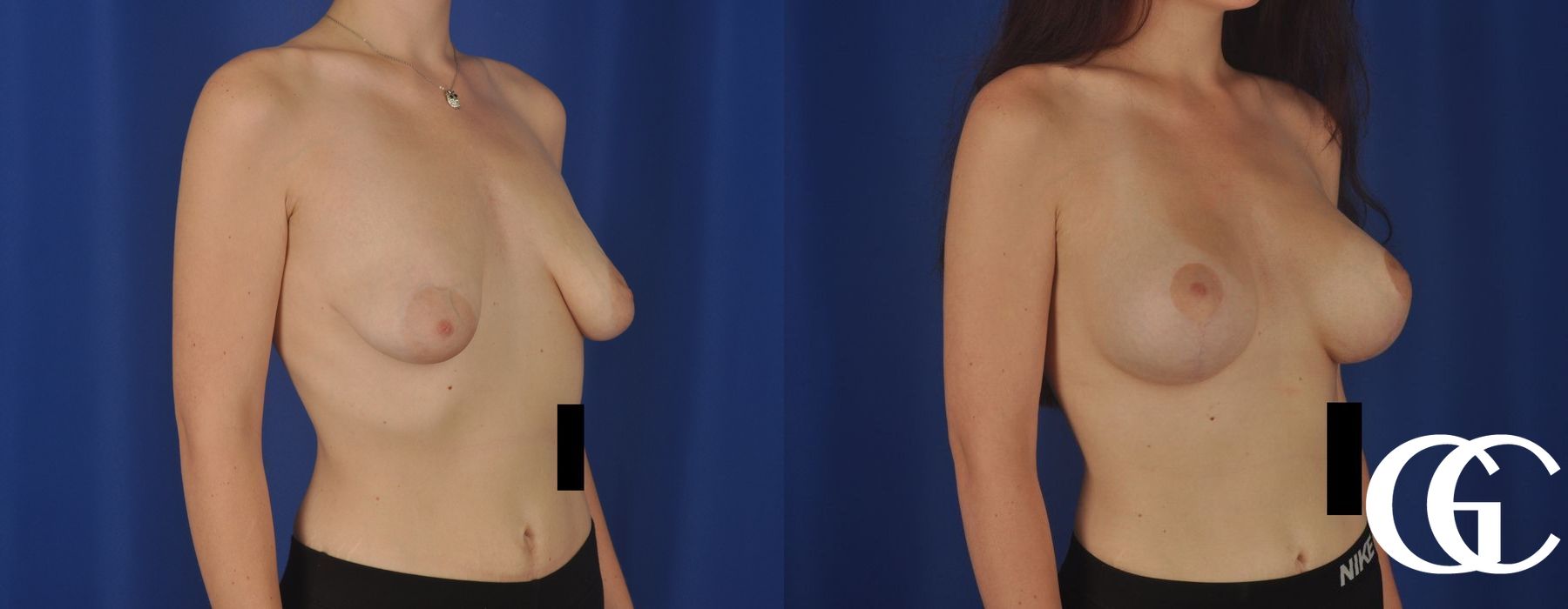 Breast Augmentation - Thumbnail 2