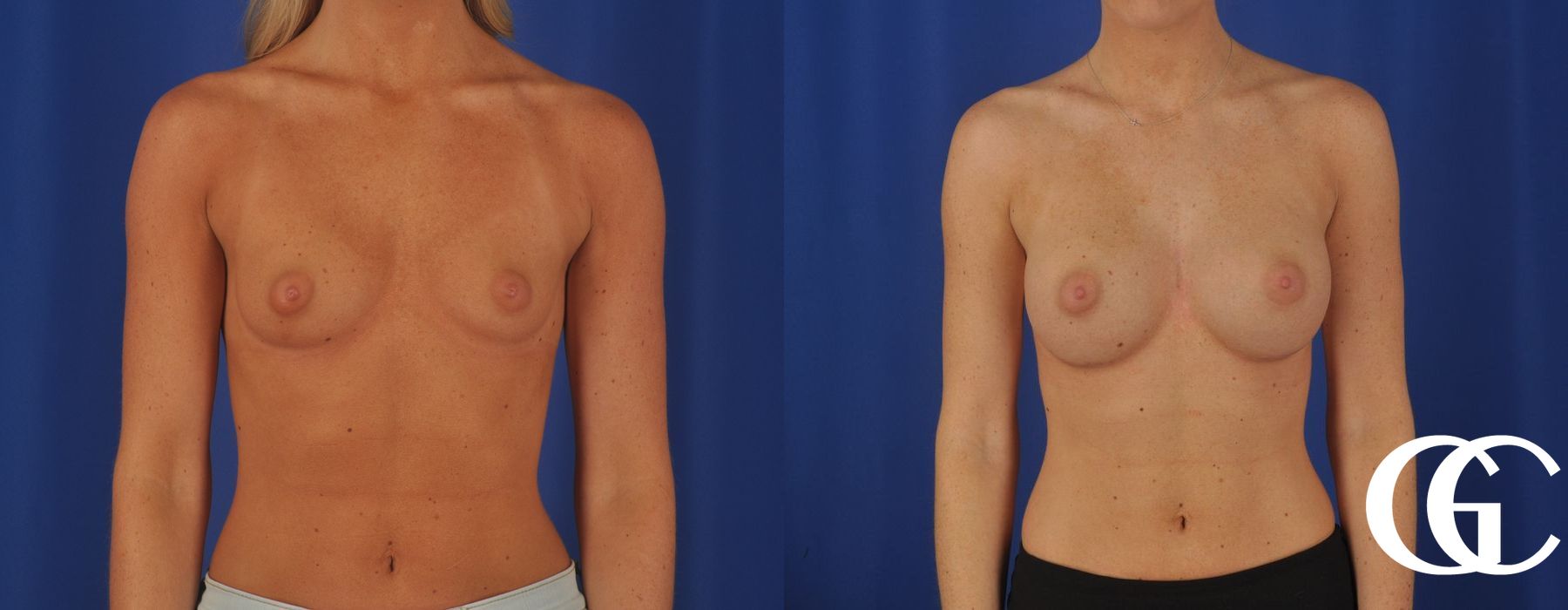 Breast Augmentation - Case 7130
