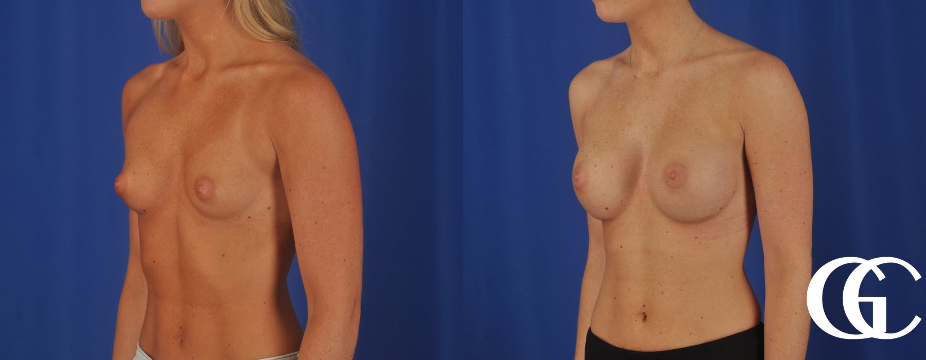 Breast Augmentation - Thumbnail 4