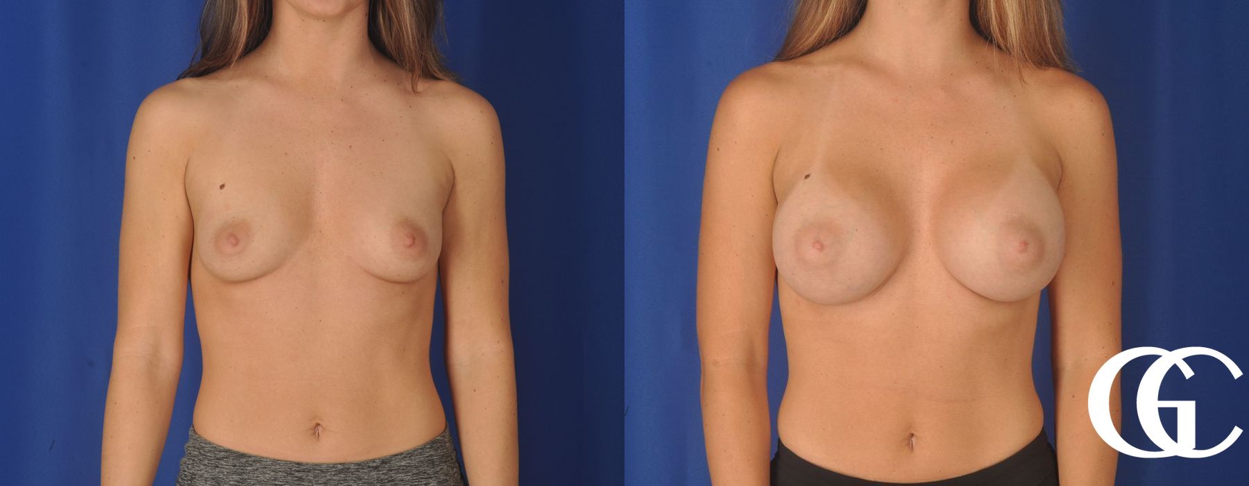 Breast Augmentation - Thumbnail 2