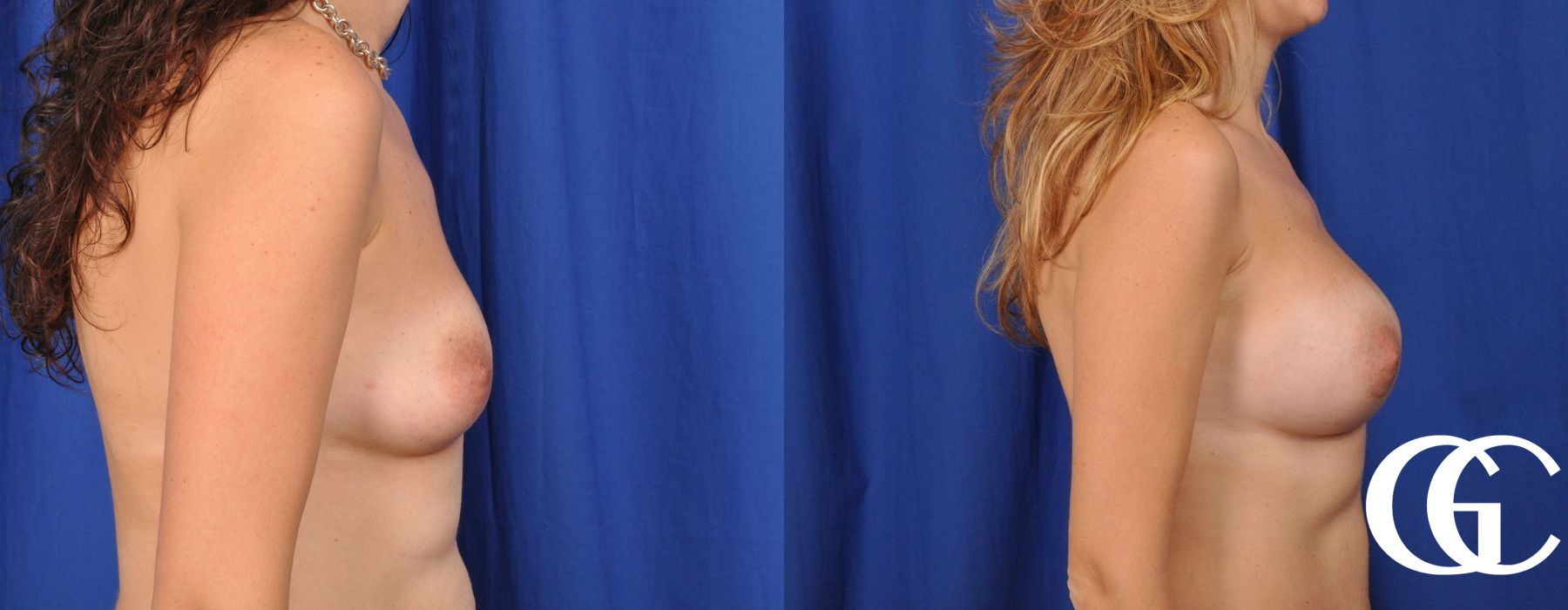 Breast Augmentation - Thumbnail 3