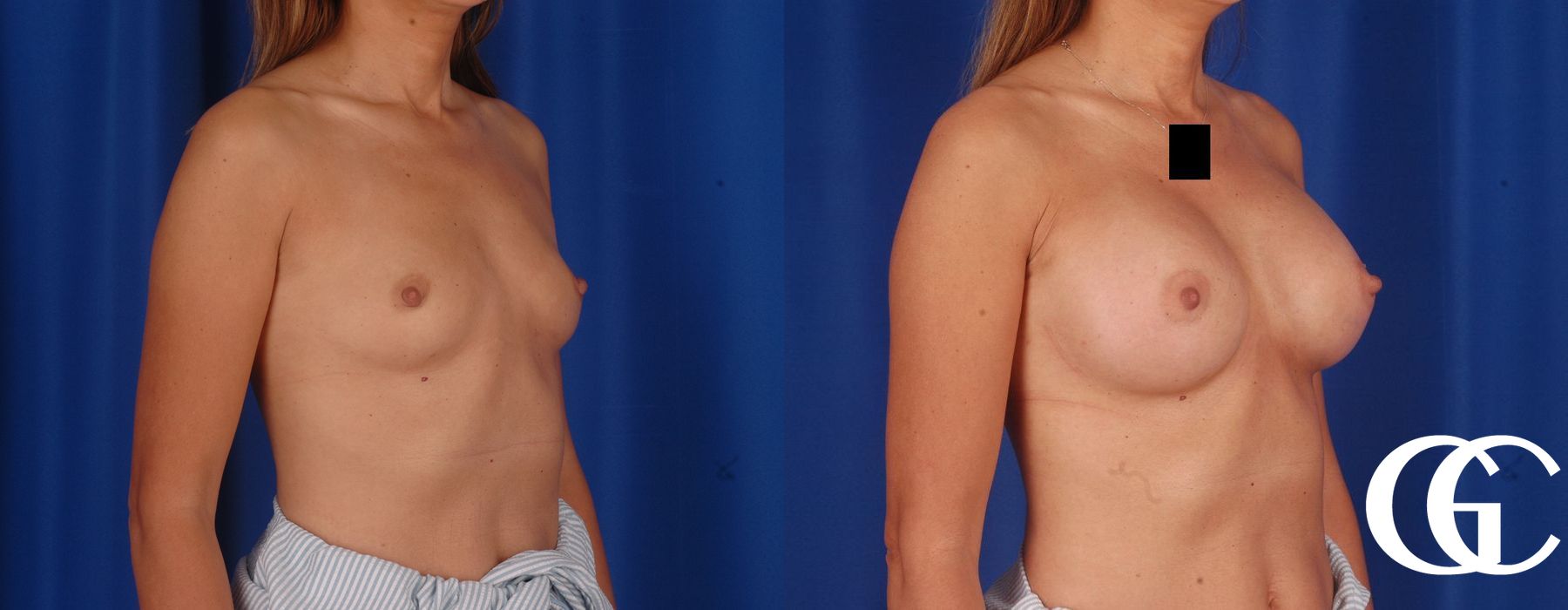 Breast Augmentation - Case 7209