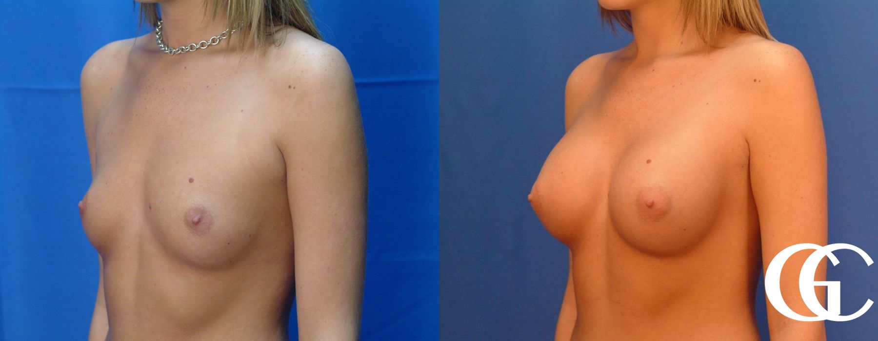 Breast Augmentation - Thumbnail 2